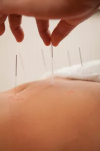 Acupuntura